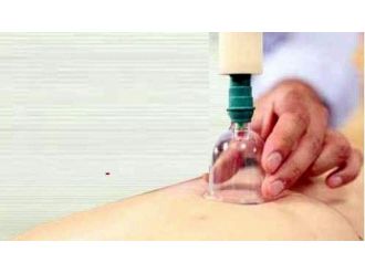 Hacamat Tedavisi Ve Bilinmeyenleri