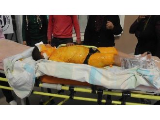 Üzerine Kaynar Su Dökülen Çocuk Haşlandı