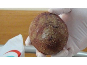 Mesanesinden 340 Gram Ağırlığında Taş Çıkarıldı