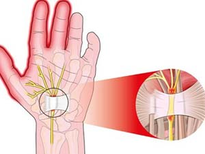 Karpal Tünel Sendromu