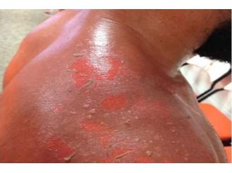 Sıcak Çarpması Ölümle Sonuçlanabiliyor