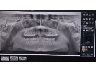Gazi Hastanesinde Dental Radyoloji Ünitesi Açıldı