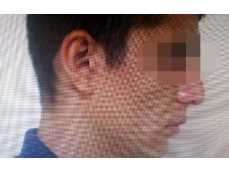 Yüzündeki Yara İzi Hırsızı Ele Verdi