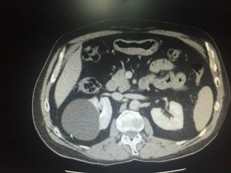 Böbrek Kistlerine Laparoskopik Çözüm