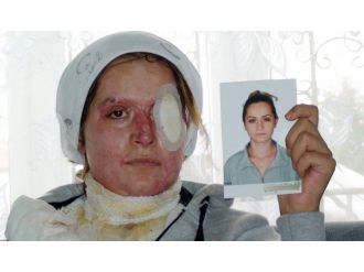 Kocasının kezzapla bu hale getirdiği kadın yardım bekliyor