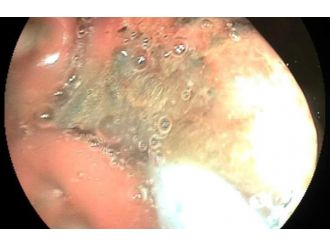 Mahkumun midesinden öyle bir şey çıktı ki!