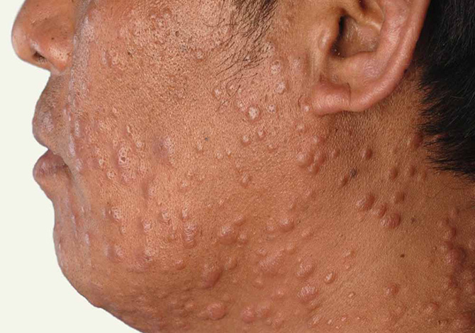 Dünya Cüzzam (Lepra) Haftası