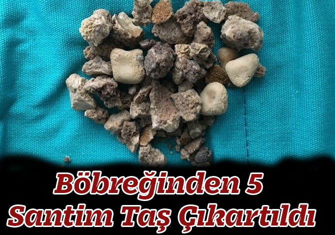 Böbreğinden 5 Santim Taş Çıkartıldı