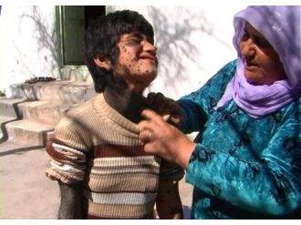 Suriyeli kızın dramı ! Yardım bekliyor