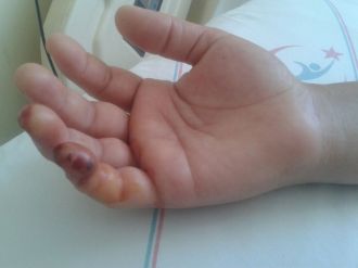 Zehirli balık kadını hastanelik etti: Dokunması yetti !