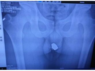 Çaldığı ziynet eşyaları röntgenle ortaya çıktı