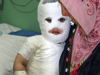 Süt kazanına düşen çocuk feci şekilde yandı