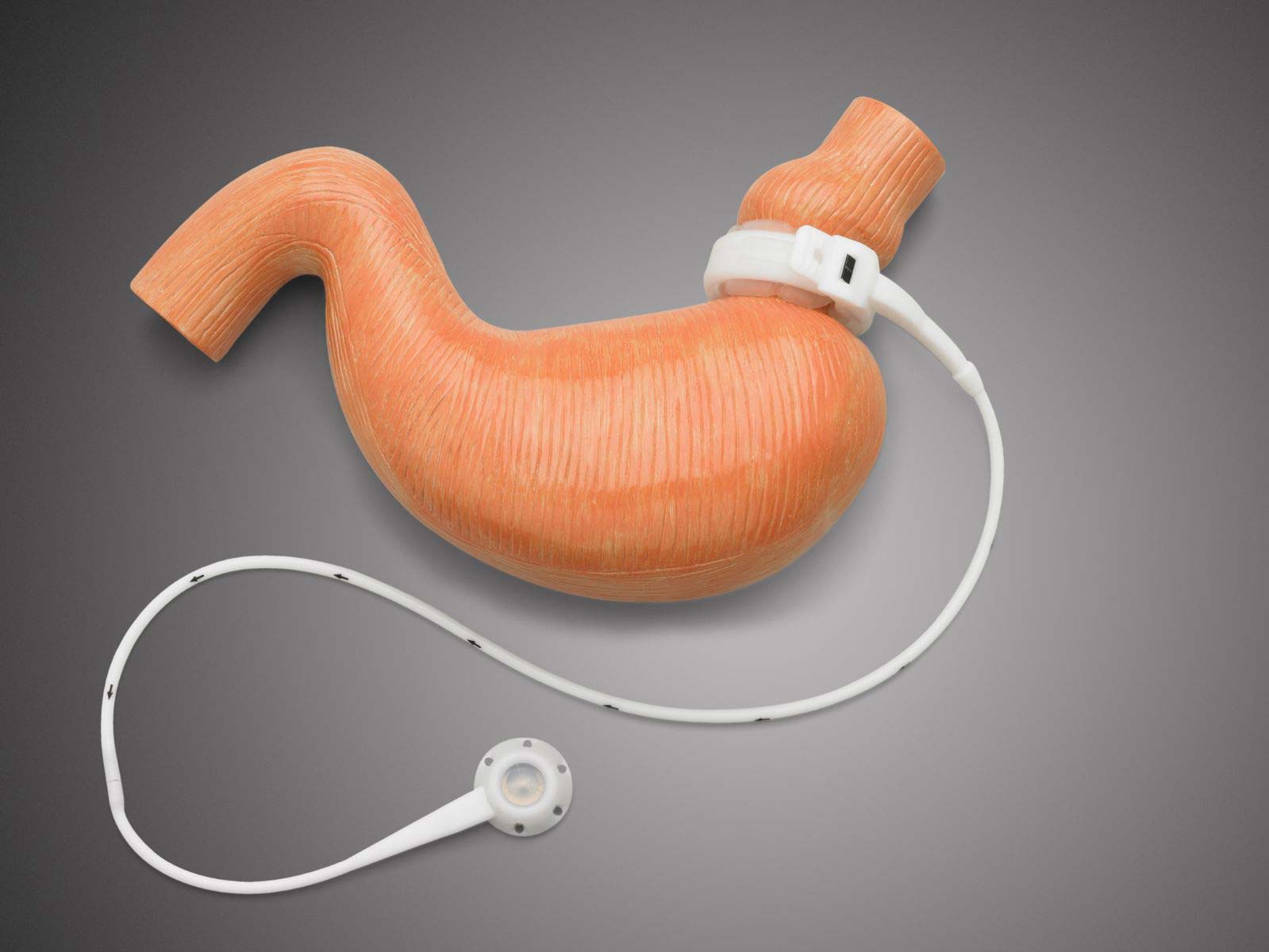 Obeziteye Cerrahi Çözüm 