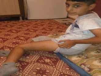 Oyun oynarken köpeğin saldırısına uğradı