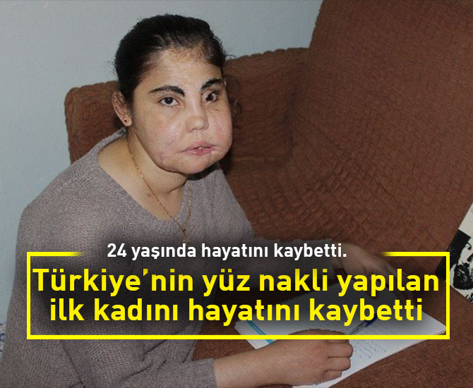Türkiye’nin yüz nakli yapılan ilk kadını hayatını kaybetti
