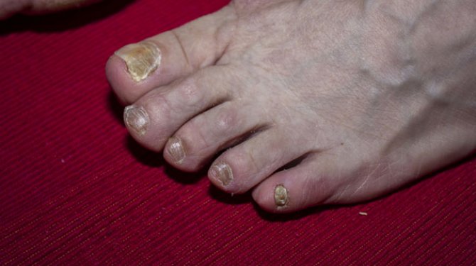 Ayak tırnağındaki mantar nasıl tedavi edilir?