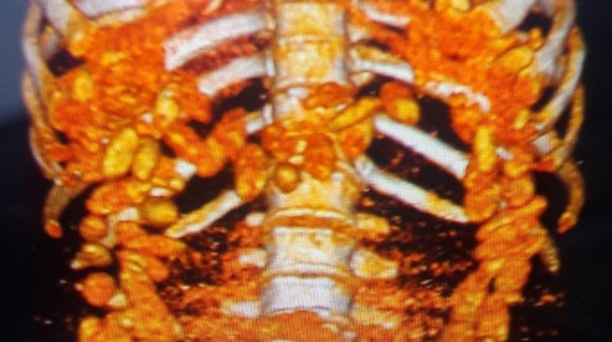 Güney Afrikalı kaçakçının Sindirim sisteminden kokain çıktı