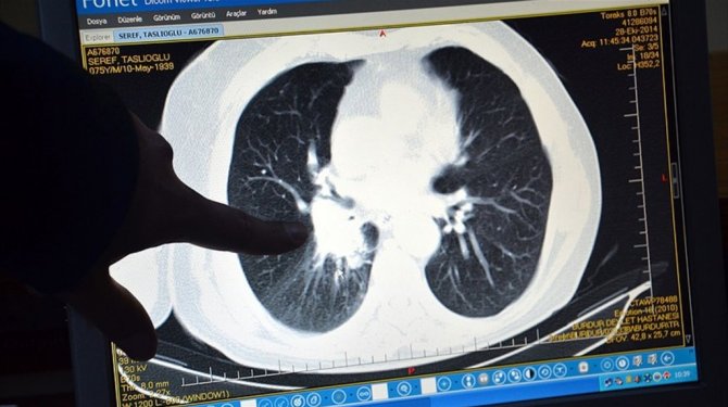 Türkiye'de erkeklerde en sık akciğer kanseri görülüyor