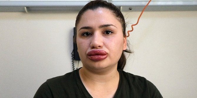 HEMŞİREYİ BU HALE GETİREN KUAFÖR HAKKINDA SUÇ DUYURUSU