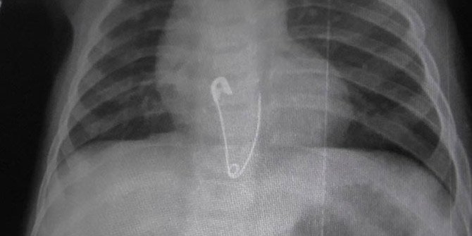 9 AYLIK BEBEK ÇENGELLİ İĞNE YUTTU