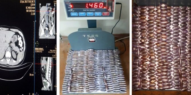 MİDESİNDEN 78 KAPSÜL UYUŞTURUCU ÇIKTI