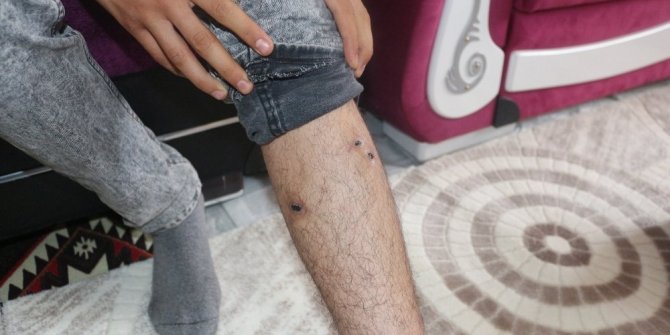 AĞRI’DA KUDUZ KÖPEK DEHŞETİ: 1 ÖLÜ