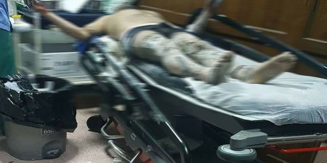 ELEKTRİK TRAFOSUNDA PATLAMA: 2 YARALI