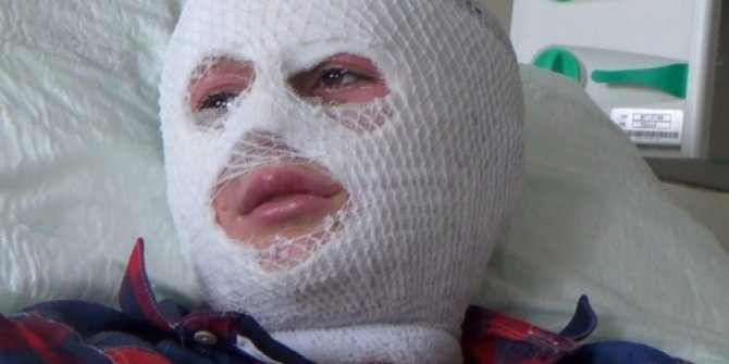 PATLAYAN PARFÜM ŞİŞESİ YÜZÜNÜ BU HALE GETİRDİ