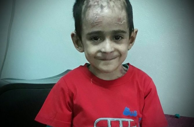 KELEBEK HASTALIĞI ÇOCUKLARIN HAYATLARINI ÇALIYOR