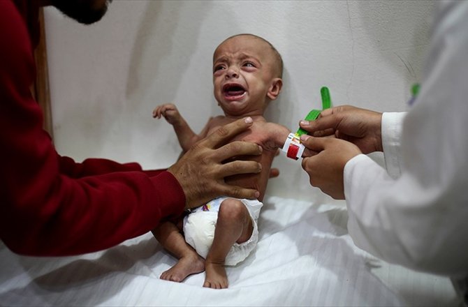 'DOĞU GUTA'DA YETERSİZ BESLENEN ÇOCUKLARIN SAYISI ÜRKÜTÜCÜ BOYUTLARDA'