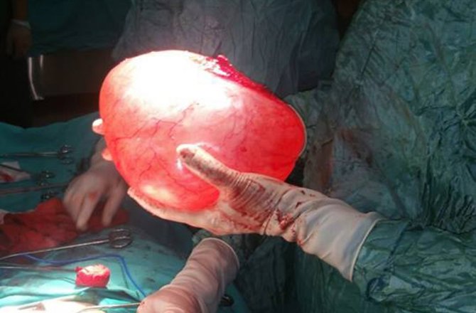 BU BİR İNSANIN KARNINDAN ÇIKTI !