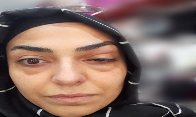 Botoks yaptırdı: Gözünden oluyordu