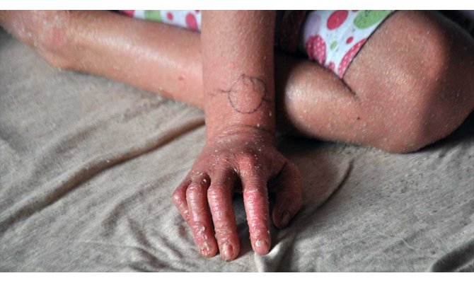 Bakan Koca'dan 'balık pulu' hastalarına müjde
