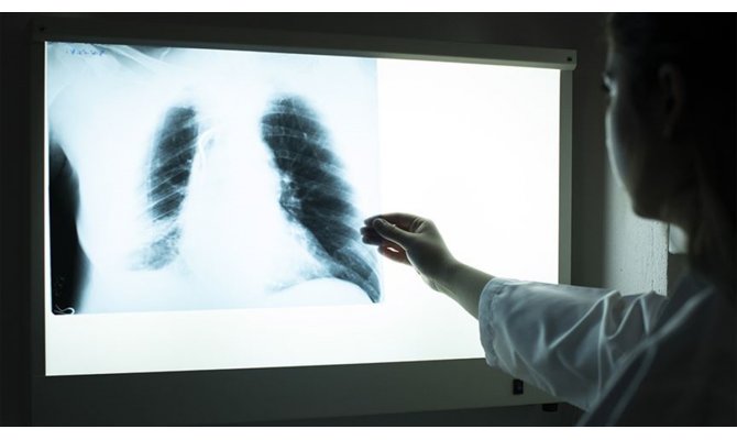 Solunum sistemi hastalıkları her yıl milyonlarca can alıyor