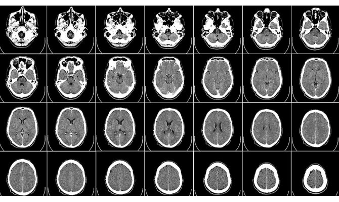 Obez çocukların beyinlerinde yapısal farklılıklar gözlendi
