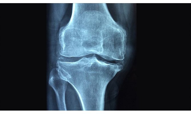 Romatizmal hastalıklar 'osteoporoz' riskini artırıyor