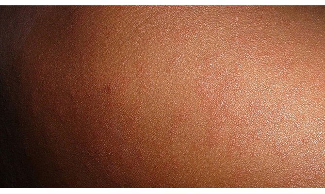 Kızamık vücuda enfeksiyonla mücadeleyi unutturuyor