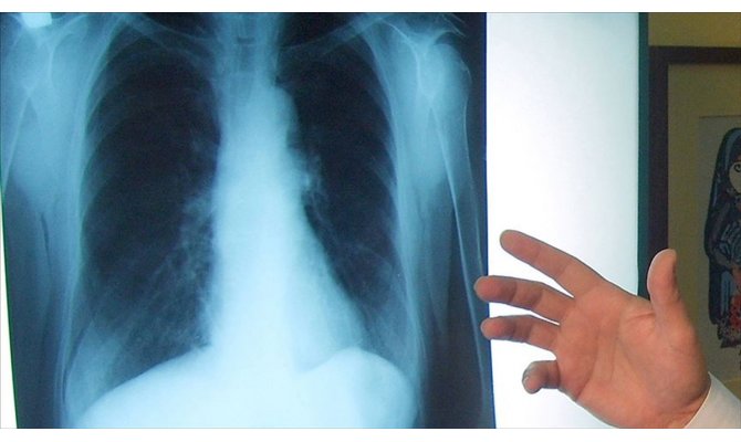 Akciğer kanserinde yeni tedavi yöntemleri sağ kalım süresini artırıyor