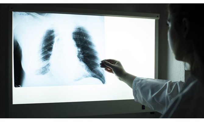 Her 10 hastadan biri KOAH tanısı alıyor