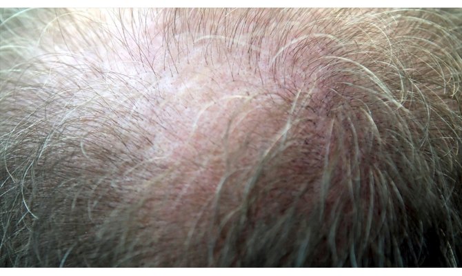 Saç dökülmesinin üç aydan uzun sürmesi hastalık habercisi