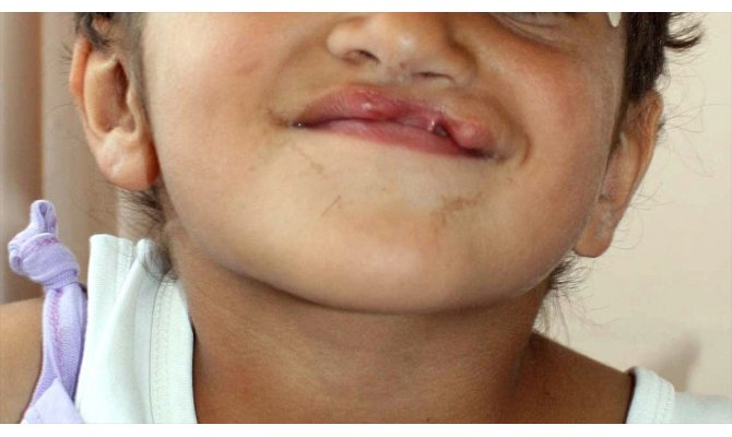 Gebelikte ilaç kullanımında 'dudak ve damak yarığı' riski