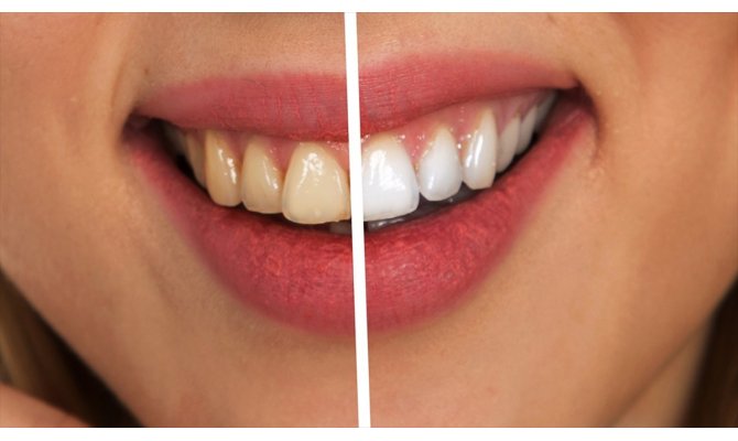 Gülüş estetiğine sahip olmamak öz güven eksikliği yaratabilir