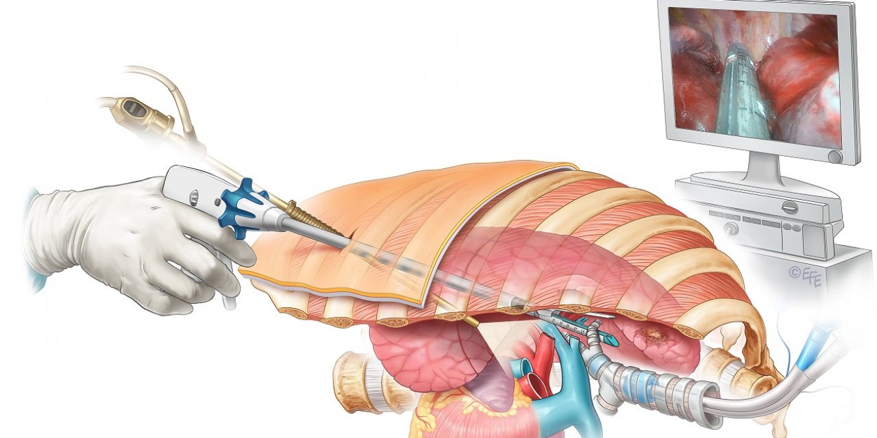 Akciğer kanseri cerrahisinde tek ve küçük kesiden ameliyat yapılıyor