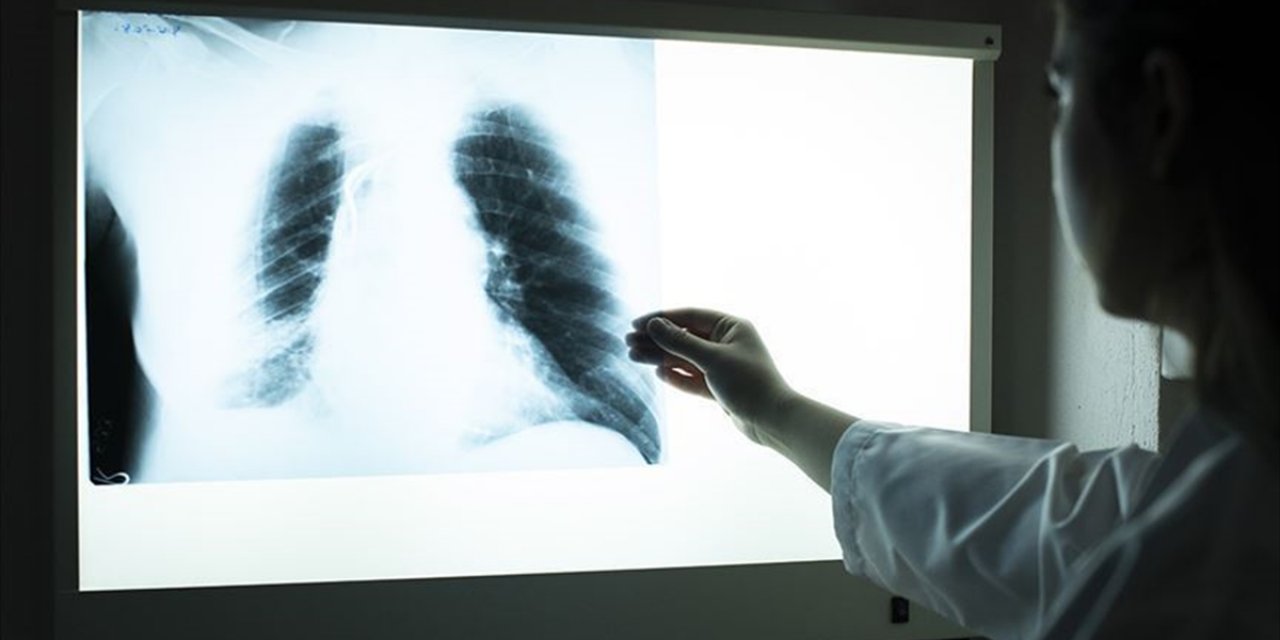 Akciğer kanseri vakalarının yüzde 95'inden sigara sorumlu