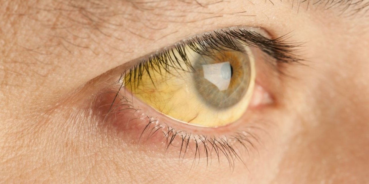 Türkiye’de hepatit B virüsü taşıyan 3,5 milyon insan bulunuyor