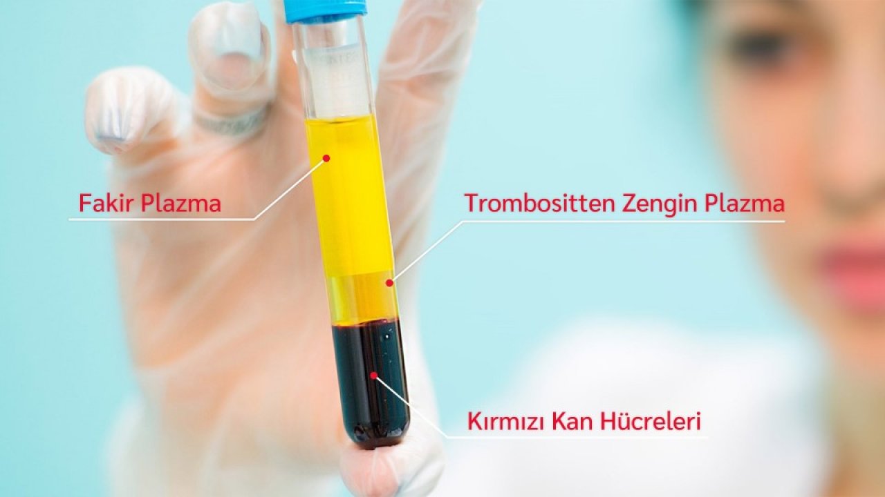 Sertleşme Bozukluğunda PRP Tedavisi