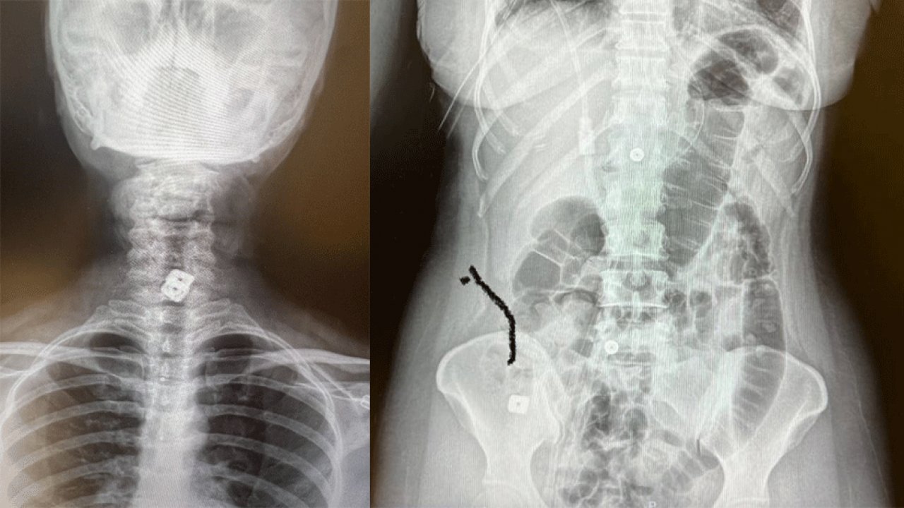 SAKO’da tıp tarihine geçen olay! Boyuna takılan disk yemek borusunu delip mideye indi!