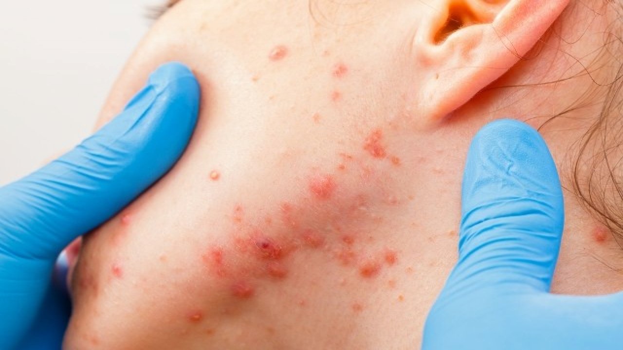 Akne sadece ergenlik döneminin sorunu değil!