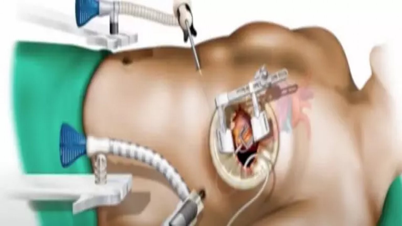 Kapalı kalp ameliyatı cinsellikte erken dönüş sağlıyor! 