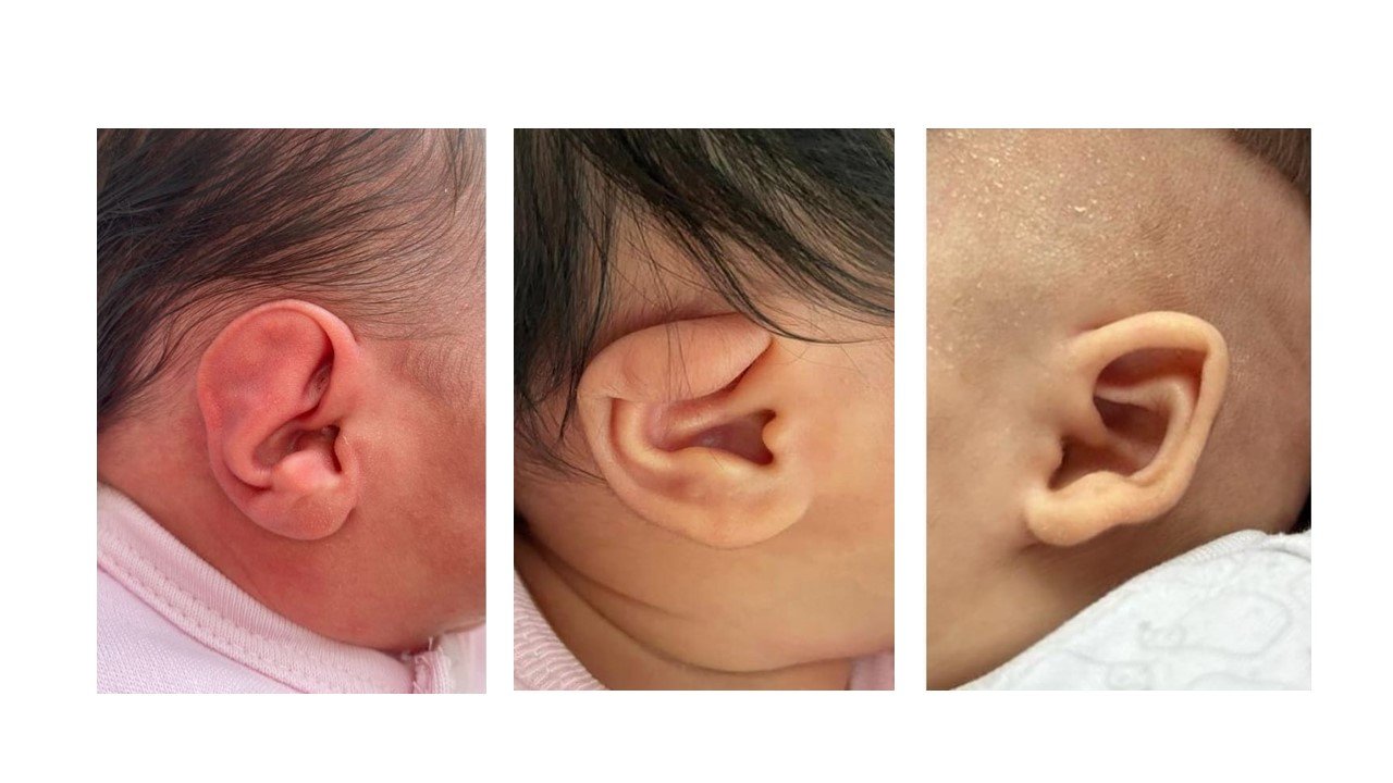 Bebeklerde şekli bozuk kulaklara dikkat!